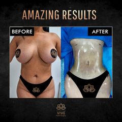 Lipoescultura - Vive Plastic Surgery