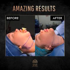 Liposucción de Papada - Vive Plastic Surgery