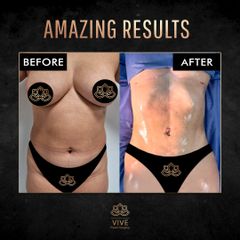Liposucción - Vive Plastic Surgery