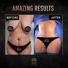 Tummy Tuck ( Abdominoplastia)