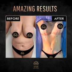 Mommy Makevor- Vive Plastic Surgery
