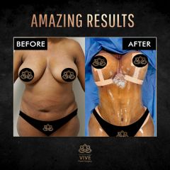 Mommy Makeover - Vive Plastic Surgery