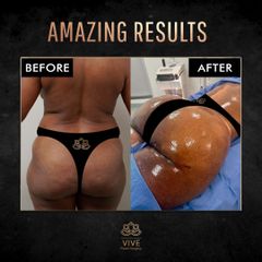 Gluteoplastia - Vive plastic surgey