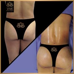 Gluteoplastia (BBL) Vive Plastic Surgey