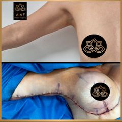 Braquioplastia - Vive Plastic Surgery