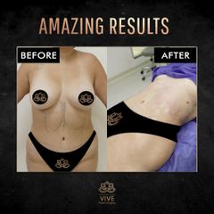 Liposuccion- Vive Plastic Surgery