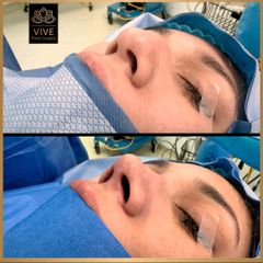 Rinoplastia- Vive Plastic Surgery