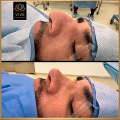 Rinoplastia - Vive Plastic Surgery