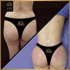 BBL (Gluteoplastia) - Vive Plastic Surgeryy