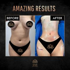 Lipoescultura - Vive Plastic Surgery
