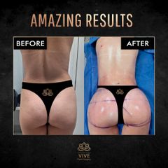 Gluteoplastia (BBL), before & after - Vive Plastic Surgery