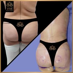 Gluteoplastia (BBL) - Vive Plastic Surgery