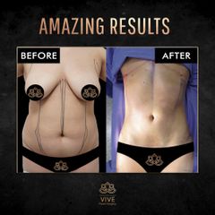Liposuccion - Vive Plastic Surgery