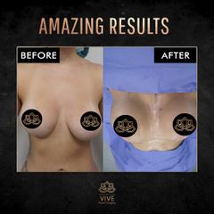 Aumento de busto (breast implants) before & after - Vive Plastic Surgery