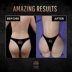 Gluteoplastia, Before & After - Vive Plastic Surgery