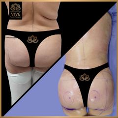 Gluteoplastia (BBL), Before & After - Vive Plastic Surgery