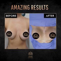 Aumento de busto (breast implants) - Vive Plastic Surgery