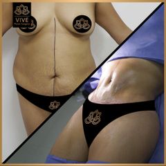 Abdominoplastia (tummy tuck), Before & After - Vive Plastic Surgery
