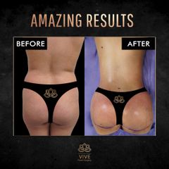 Gluteoplastia, (BBL) Before & After - Vive Plastic Surgery