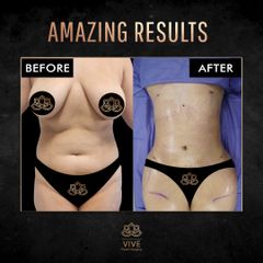 Liposucción, Before & After. Mujer entre la edad de 20 a 29 años- Vive Plastic Surgery