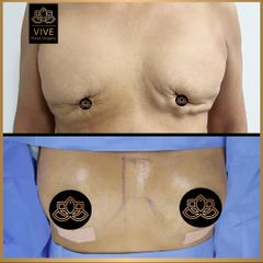 Aumento de busto (breast implants) - Vive Plastic Surgery