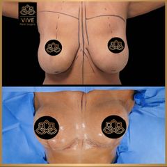 Mastopexia (breast lift) - Vive Plastic Surgery