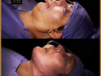 Cirugía facial antes y después - 868054