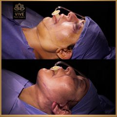 Ritidectomía (Cirugia Facial) - Vive Plastic Surgery