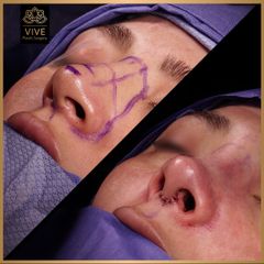 Rinoplastia (rhinoplasty) - Vive Plastic Surgery