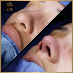 Rinoplastia (rhinoplasty) - Vive Plastic Surgery