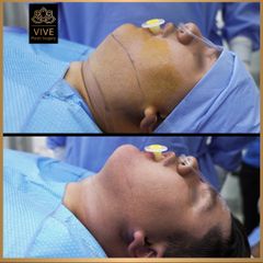 Cirugia de papada (Chin Lipo) - Vive Plastic Surgery
