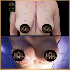 Mastopexia (breast lift) - Vive Plastic Surgery