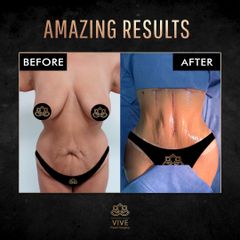 Abdominoplastia (tummy tuck) - Vive Plastic Surgery
