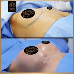 Aumento de busto (breast implants) - Vive Plastic Surgery