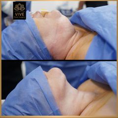 Cirugia de papada (Chin Lipo) - Vive Plastic Surgery