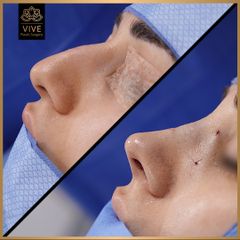 Rinoplastia (rhinoplasty) - Vive Plastic Surgery