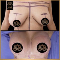 Mastopexia (breast lift) - Vive Plastic Surgery