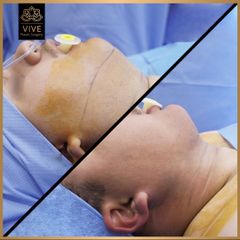 Cirugia de papada (Chin Lipo) - Vive Plastic Surgery