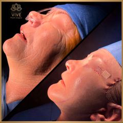 Cirugia facial (Face Lift) - Vive Plastic Surgery