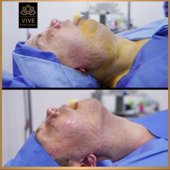 Cirugia de papada (Chin Lipo) - Vive Plastic Surgery