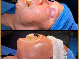 Cirugía facial antes y después - 869558