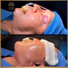 Cirugia facial (Face Lift) - Vive Plastic Surgery