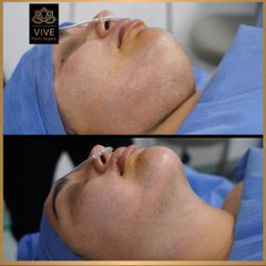 Cirugia de papada (Chin Lipo) - Vive Plastic Surgery