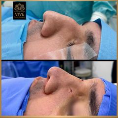 Rinoplastia (rhinoplasty) - Vive Plastic Surgery