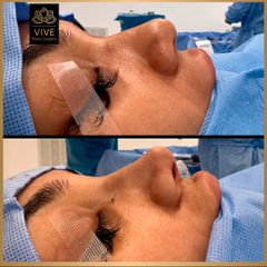 Rinoplastia (rhinoplasty) - Vive Plastic Surgery