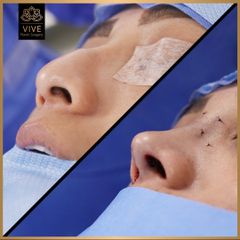 Rinoplastia (rhinoplasty) - Vive Plastic Surgery