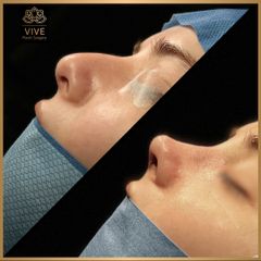 Rinoplastia (rhinoplasty) - Vive Plastic Surgery