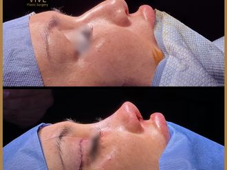 Rinoplastia antes y después - 870153