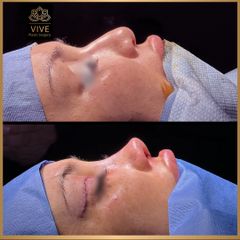 Rinoplastia (rhinoplasty) - Vive Plastic Surgery