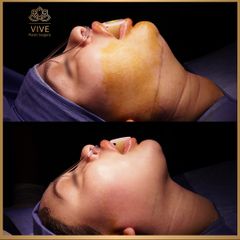 Cirugia de papada (Chin Lipo) - Vive Plastic Surgery